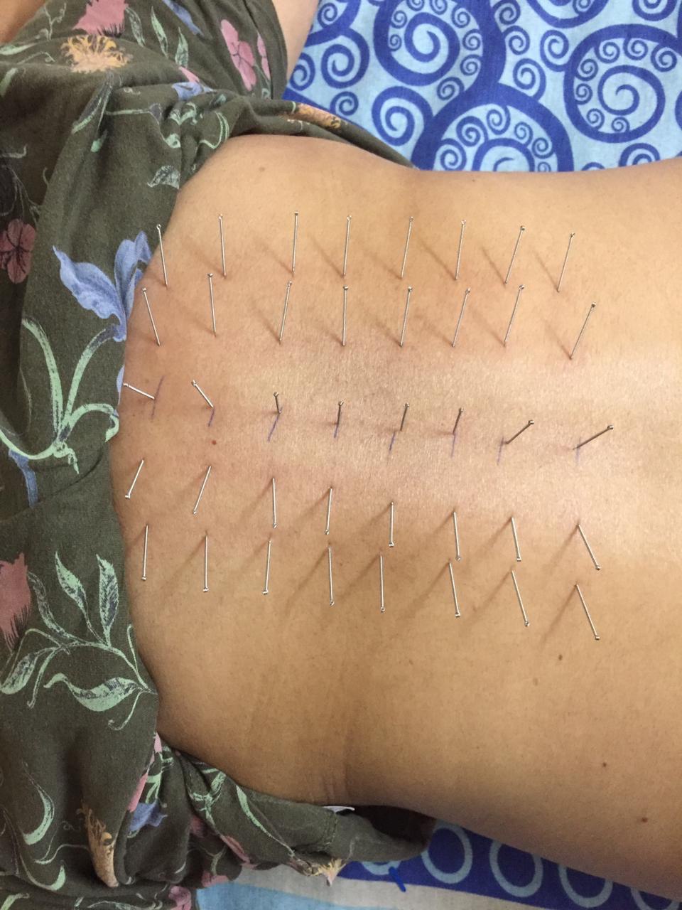 Acupuncture Treatment